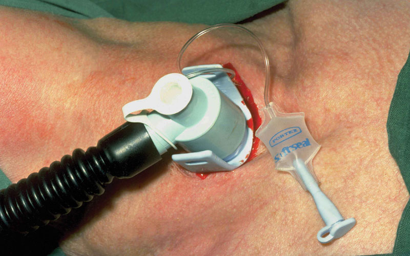 Tracheostomy Tube Change